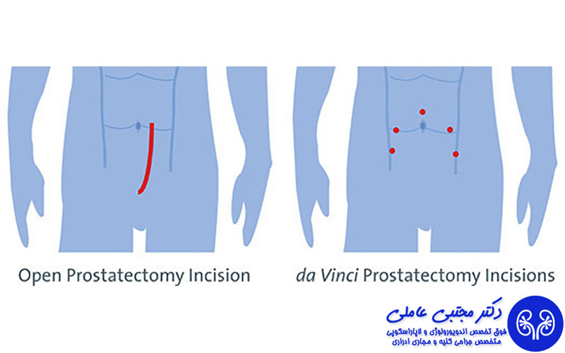 جراحی بسته پروستات در تهران