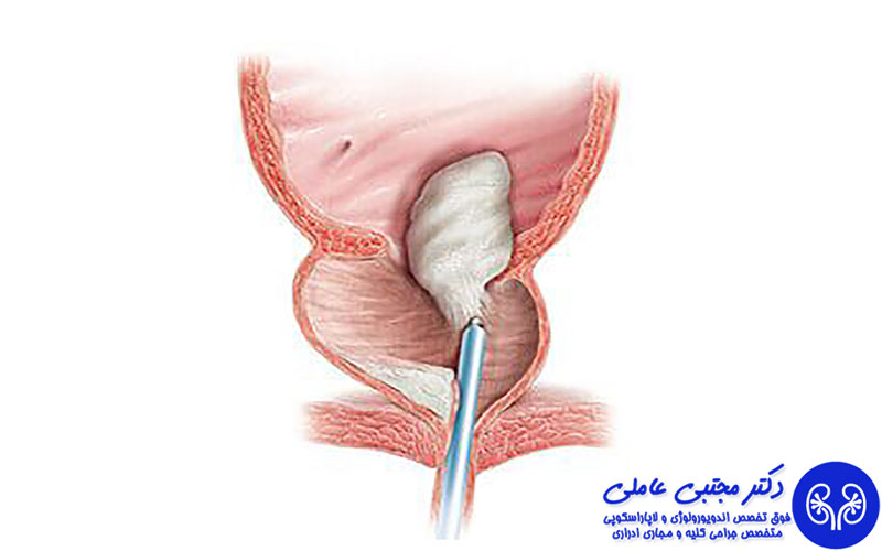 جراحی پروستات با لیزر هولمیوم holep