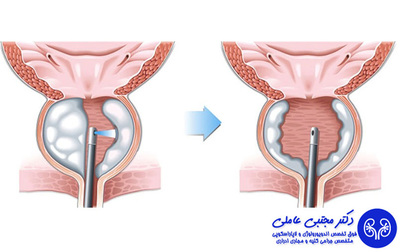 جراحی پروستات با لیزر هولمیوم holep