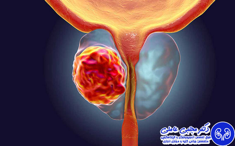 درمان پروستات بدخیم