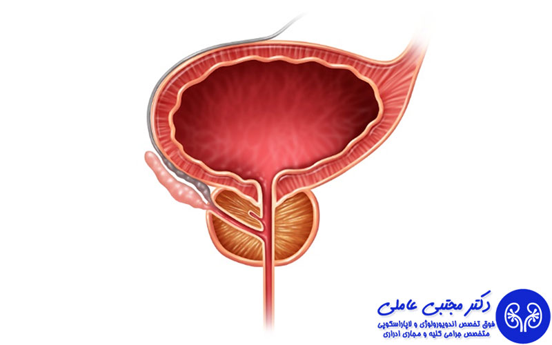 درمان بزرگی پروستات بدون جراحی