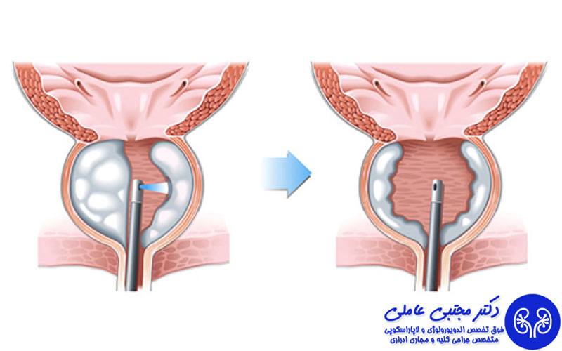جراحی لیزری پروستات