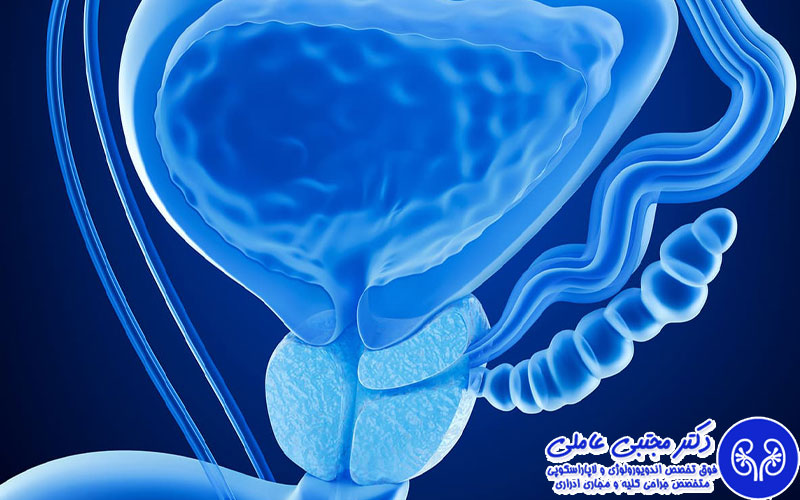 چه چیزی باعث سرطان پروستات می‌شود