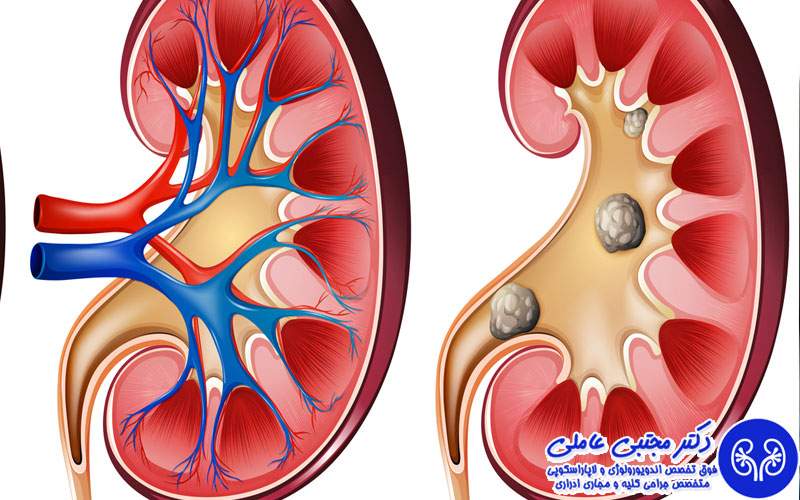 خونریزی بعد از دفع سنگ کلیه