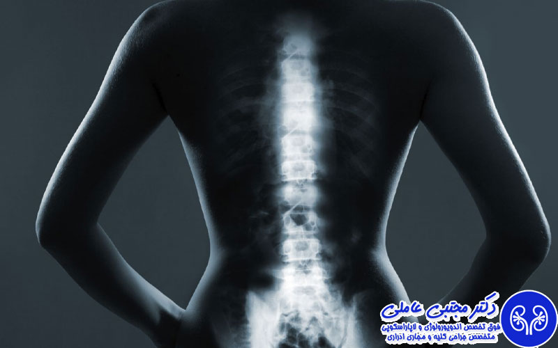 متاستازهای استخوانی کنسر پروستات