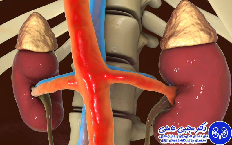 دلیل خون ریزی بعد از دفع سنگ مثانه