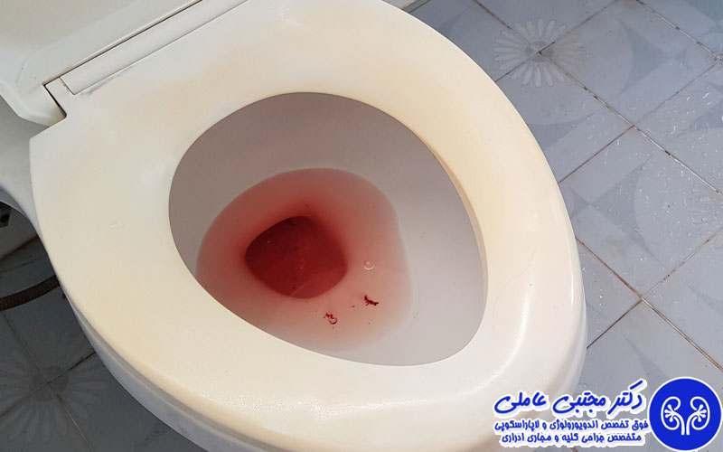 دلیل خون ریزی بعد از دفع سنگ مثانه