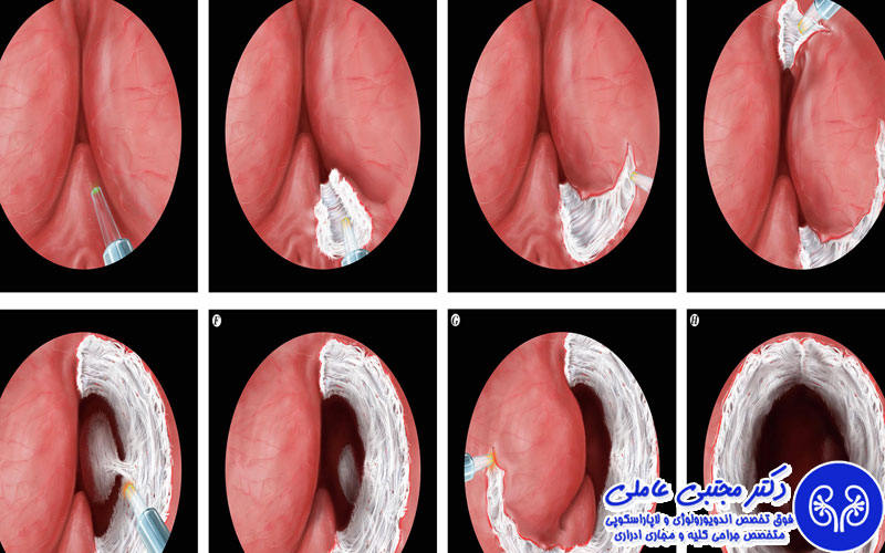 جراحی هولپ و سایز پروستات