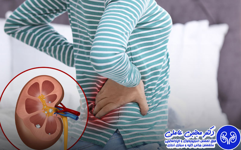 آیا تشکیل سنگ کلیه درد دارد