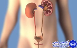 استنت حالبی چیست