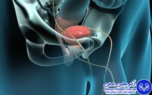 عوارض جراحی باز پروستات