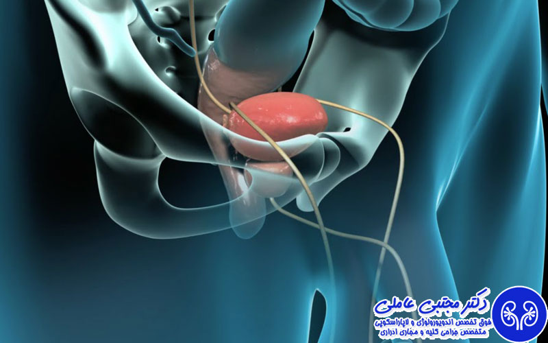 عوارض جراحی باز پروستات