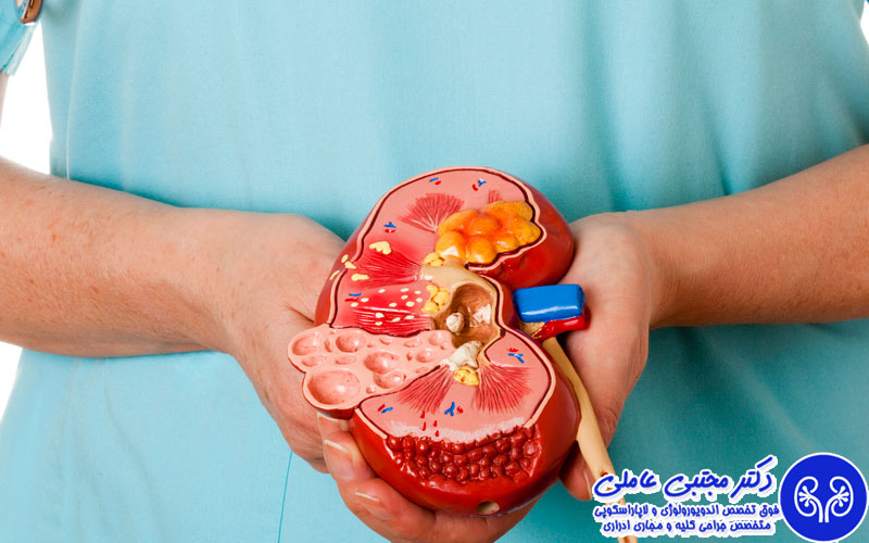 جراحی سنگ کلیه به روش ریرس