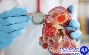 جراحی سنگ کلیه به روش ریرس