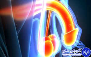 انواع عمل جراحی واریکوسل