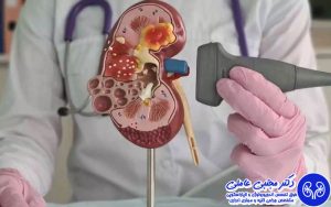 جراحی ریرس برای درمان سنگ کلیه