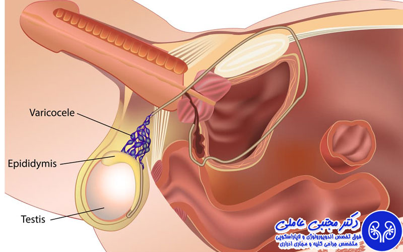 تفاوت واریکوسل و سرطان بیضه