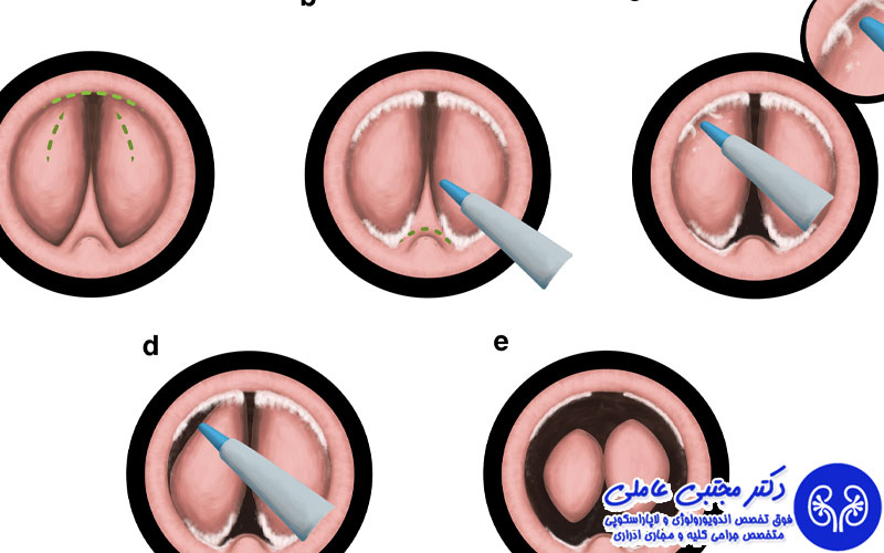 مزایای جراحی هولپ