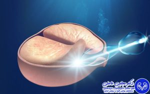 درمان پروستات خوش خیم با هولپ