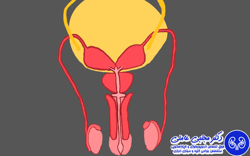 عوارض عدم درمان بزرگی پروستات