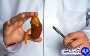 در جراحی ریرس، قطعات سنگ در کلیه پخش می شود