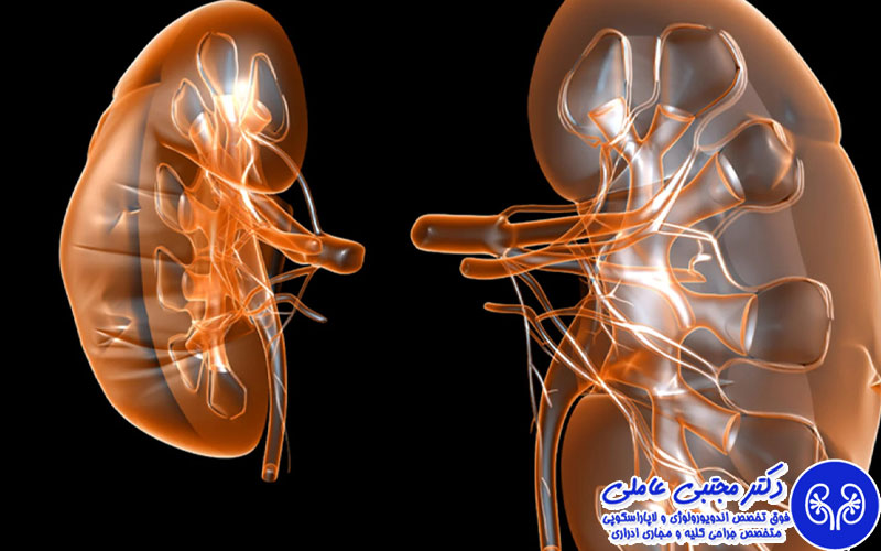 در جراحی ریرس، قطعات سنگ در کلیه پخش می شود