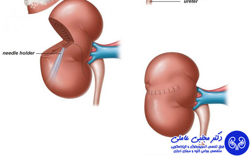 در جراحی ریرس، قطعات سنگ در کلیه پخش می شود