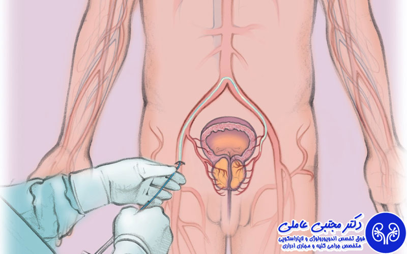 عوارض جراحی باز بزرگی پروستات