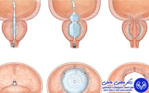 عوارض جراحی باز بزرگی خوش خیم پروستات