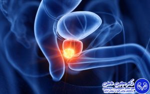 جراحی پروستات