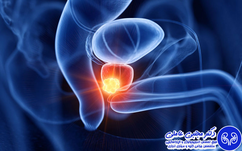 جراحی پروستات