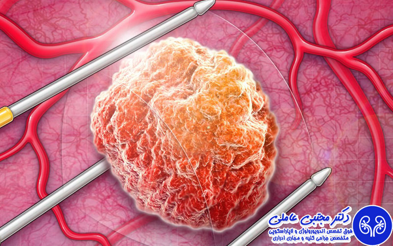 جراحی پروستات