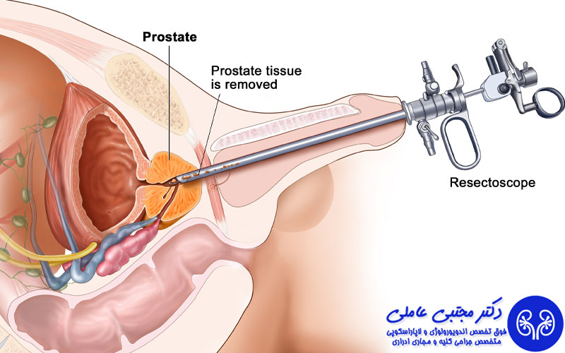 جراحی پروستات