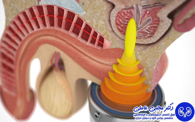 شاک ویو، راهکار نوین درمان پروستاتیت مزمن