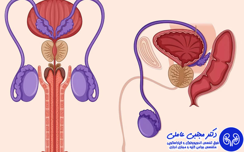 سرطان پروستات