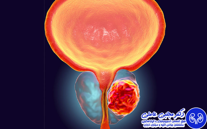 سرطان پروستات