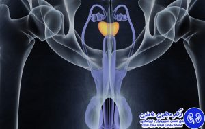 درمان دارویی و جراحی پروستاتیت مزمن