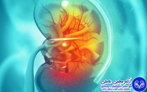 تاثیر اندازه و محل سنگ کلیه بر انتخاب نوع جراحی