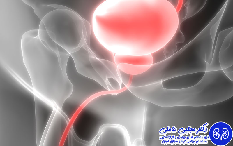 دیورتیکول مثانه