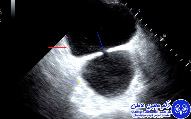 دیورتیکول مثانه
