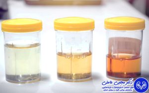 علت رنگ تیره ادرار