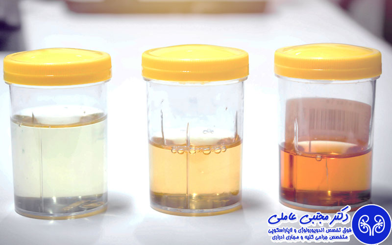 علت رنگ تیره ادرار