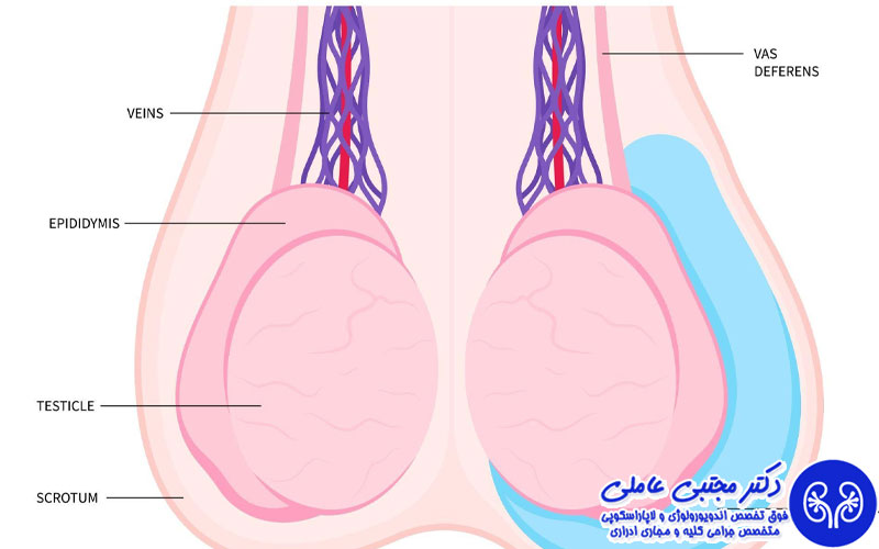 هیدروسل در بزرگسالان