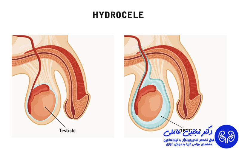 هیدروسل در بزرگسالان