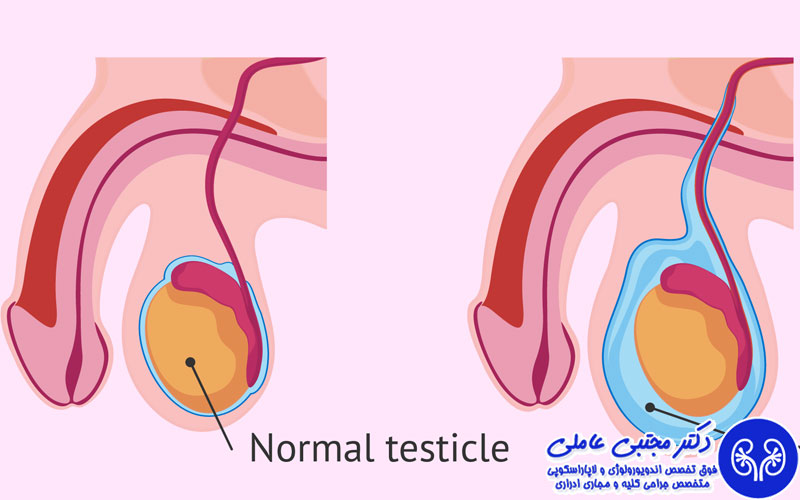 هیدروسل در بزرگسالان