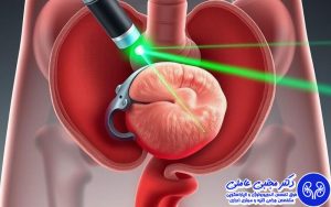 لیزر درمانی پروستات