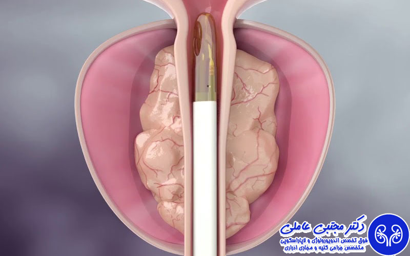 آیا جراحی لیزری پروستات برگشت‌پذیر است