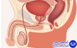 تفاوت اسپرماتوسل و سرطان بیضه