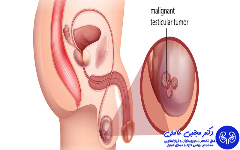 تفاوت اسپرماتوسل و سرطان بیضه