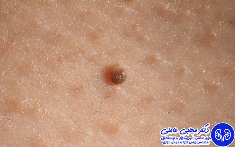 خال و زائده پوستی ناحیه تناسلی